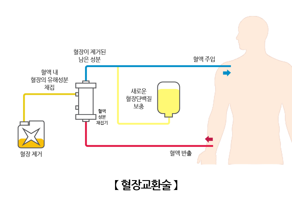혈장교환술