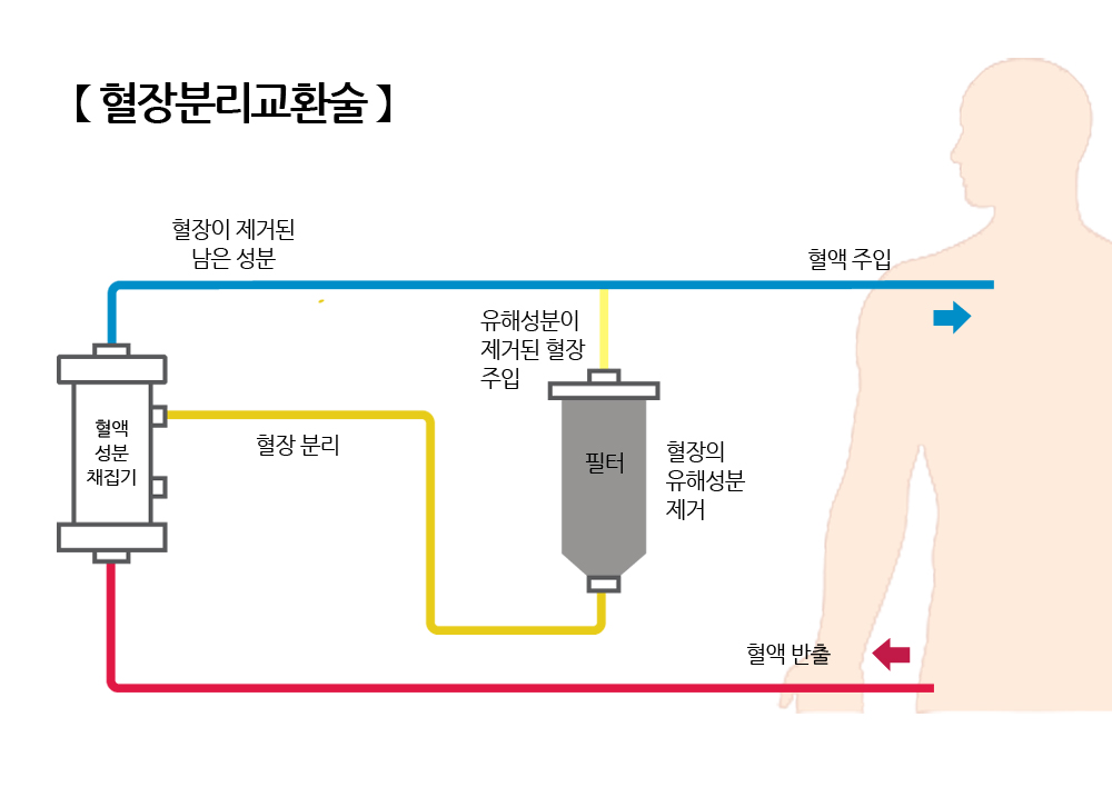 혈장분리교환술