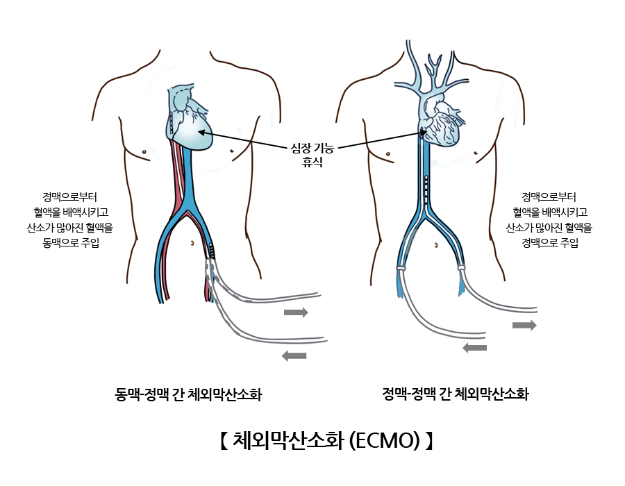 체외막산소화