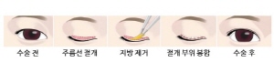 외꺼풀