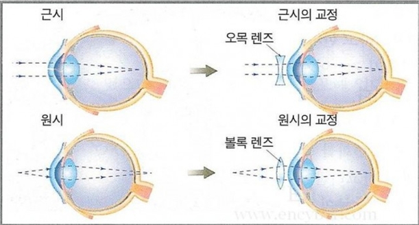 어린이 난시 설명