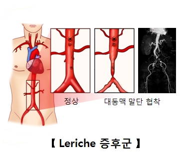 Leriche 증후군에서 혈관이 좁아져 있는 모습을 보여주는 그림