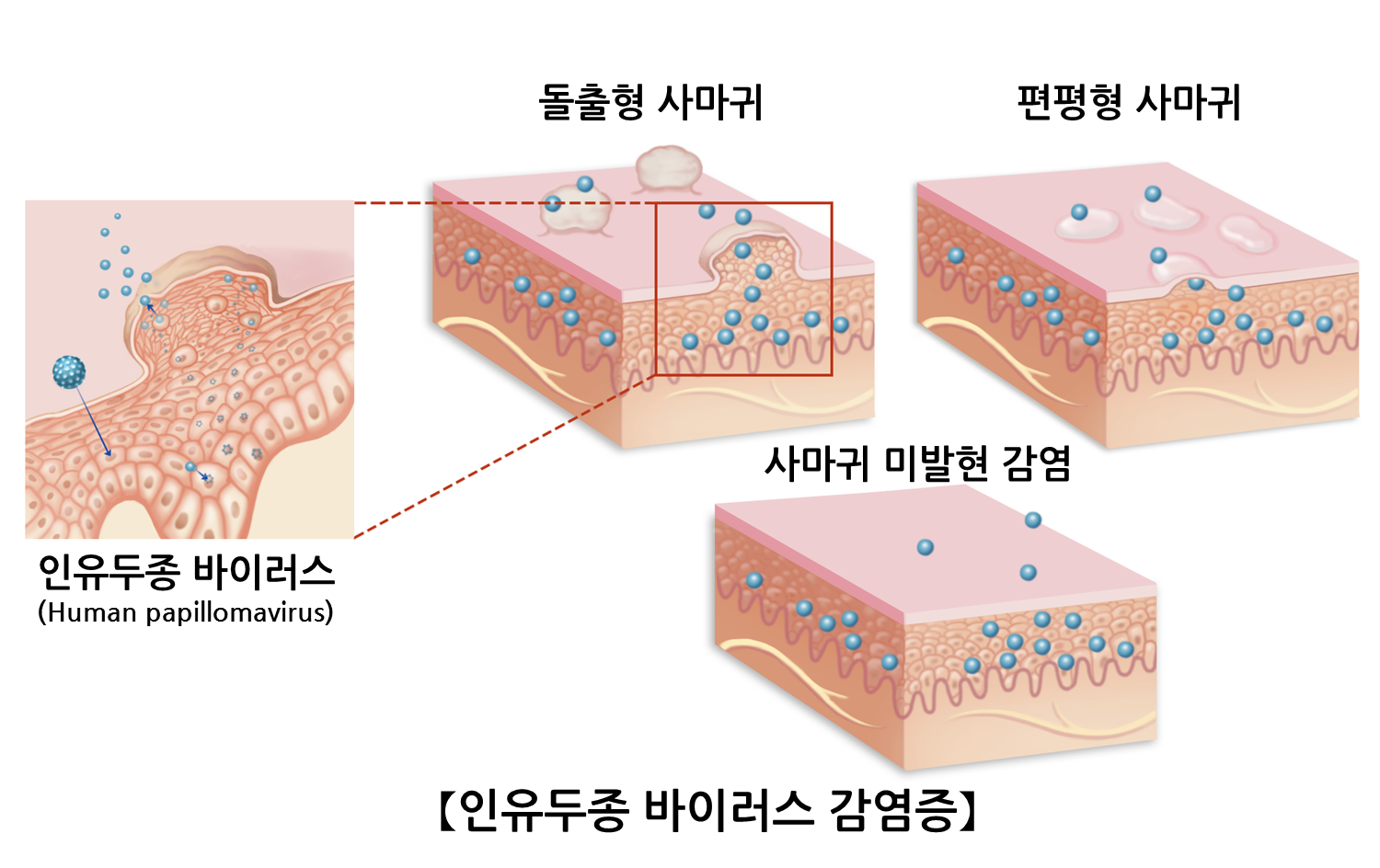 hpv바이러스가 사마귀 원인 인가요?