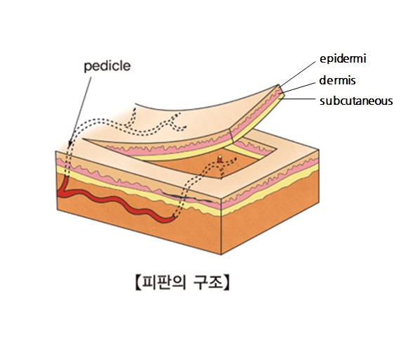부분층 피부 이식 | 검사/시술/수술정보 | 의료정보 | 건강정보 | 서울아산병원