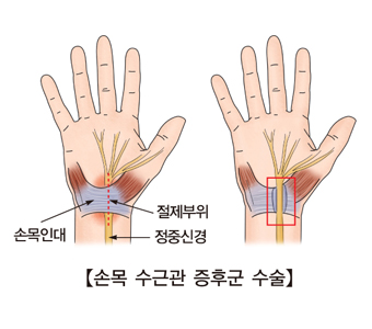 손이 저리고 손가락이 딸깍 거린다면 | 메디컬칼럼 | 건강이야기 | 건강정보 | 서울아산병원