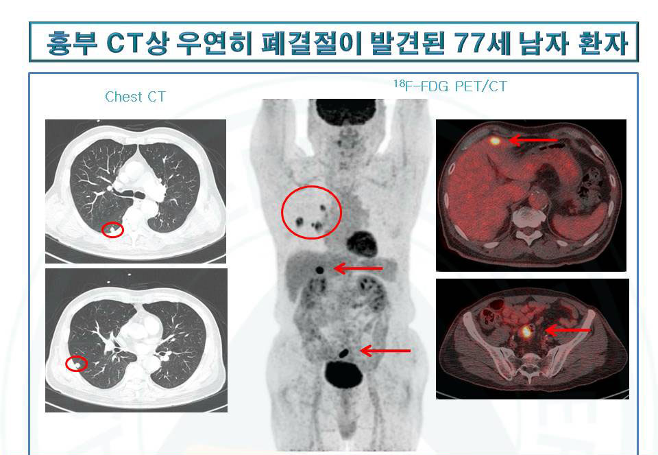[Case conference] 흉부 CT상 우연히 폐결절이 발견된 77세 남자 환자 | 핵의학 증례 영상 | 자료실 ...