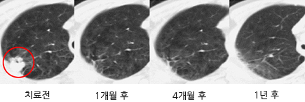 치료기간별 종양 이미지, 치료전, 1개월후, 4개월후, 1년후