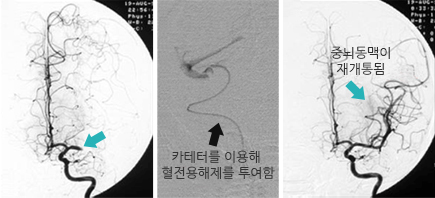 서울아산병원 뇌졸중센터 약물요법 중 하나인 혈전용해제 투여 사진 입니다.