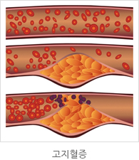 고지혈증 이미지