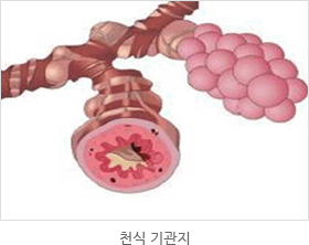 천식기관지 모습