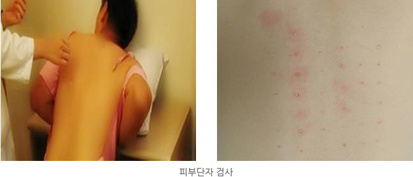 피부단자검사 장면