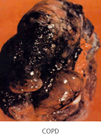 COPD 폐모습