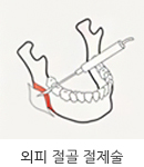 그림으로 된 외피절골 절제술 모습