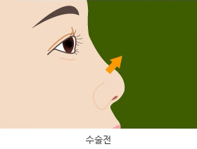 융비술 전 코 그림