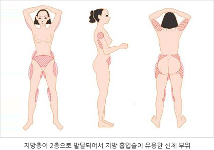 지방층이 2중으로 발달되어서 지바 흡입술이 유용한 신체 부위 아랫배, 허벅지, 팔뚝을 나타내는 이미지