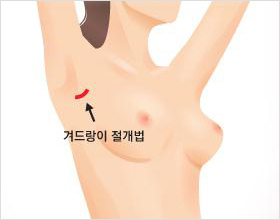 가슴이 배 위쪽에서 자연스럽게접히는 곳에 생기는 주름을 따라3~4cm 정도 절개하는 수술하는 방법입니다.직접 가슴 밑을 보면서 수술하기 때문에 수술이간편하고 수술 시간이 짧습니다.