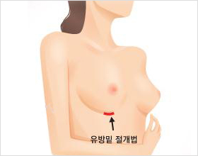 겨드랑이의 주름진 부위를3~4cm 정도 절개하는 방법입니다.수술은 상대적으로 까다로우나 흉터가 거의 보이지 않아흉터에 민감한 국내 여성들에게 만족도가 높아가장 보편적으로 시행되는 방법입니다.