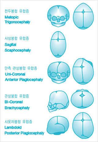 다발성 유합증에 해당하는 두개골 그림