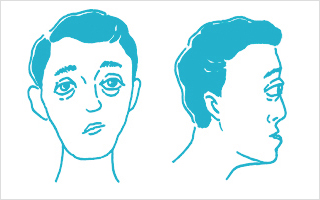 크루존(Crouzon)씨 병은 흔히 관상봉합 유합증이 동반되며 이마가 평평하고 눈이 튀어나와 있으며 코를 비롯한 얼굴 가운데 부분의 발달이 저하되어 움푹 패인 모습 그림