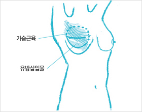 가슴근육에 인공 삽입물을 사용하는 그림
