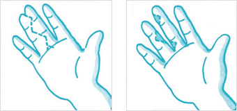 중지와 검지를 절단하여 정상적인 모습의 손가락 그림