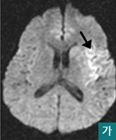 가.MRI 확산강조영상에서 좌측 뇌실질의 초기허혈성뇌경색(화살표) 모습
