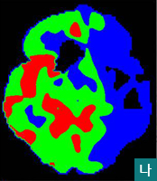 나.MRI 관류영상에서 좌측중뇌동맥영역의 심한 혈류감소모습