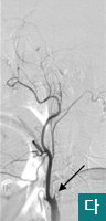 다.경동맥혈관촬영시 완전히 막힌 내경동맥모습