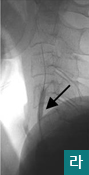 라.혈관성형술 시행모습
