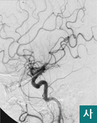 사.두개내 혈관의 혈류가 거의 정상적으로 개선된 상태모습