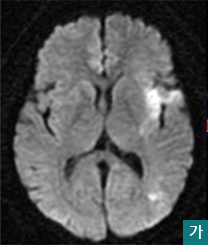 가.확산강조영상에서 좌측뇌에 약간의 초기 뇌경색모습