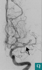 다.좌측뇌동맥혈관조영상에서 중뇌동맥이 막혀있는모습