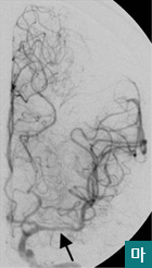 마.재개통된 중뇌동맥모습