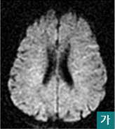 가.MRI상 뇌손상은 거의 나타나지 않은 모습