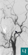 나.좌측경동맥이 박리 (dissection)에 의해 혈류가 많이 차단된 모습