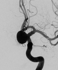 시술 전 두통과 어지러움을 호소한 76세 여자의  시술전 뇌동맥류 모습