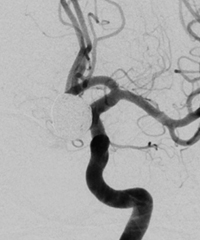 시술 후 두통과 어지러움을 호소한 76세 여자의  시술후 뇌동맥류 모습