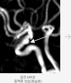 검진 MR상 동맥류 의심 모습