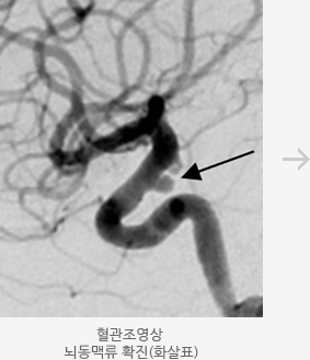 혈관조영상 뇌동맥류 확진 모습