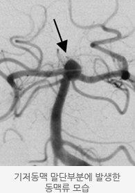  기저동맥 말단부분에 발생한 동맥류 모습