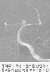  동맥류의 목에 스텐트를 삽입하여 동맥류의 넓은 목을 보호하는 모습