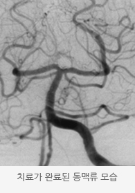  치료가 완료된 동맥류 모습