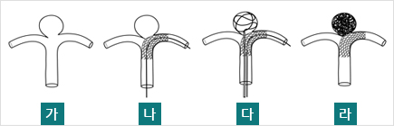 목이 넓은 동맥류의 스텐트보호색전술의  치료개념, 가~라까지 하단설명 참조