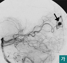  가.혈관조영상 (측면).  출혈의 원인인 가성동맥류모습