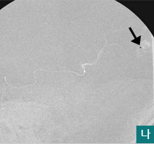  나.미세카테터로 동정맥기형내의 가성동맥류를 찾아간 모습