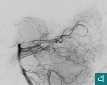  라.색전술후 혈관조영상에서 가성동맥류가 소실된 모습