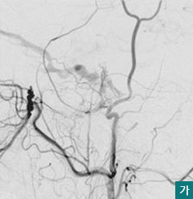  가. 외경동맥으로부터 안정맥이 차고 ,해면정맥동으로 혈류가 새고 있는 경막동정맥루임모습