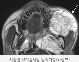 검시술전 MRI검사상 정맥기형(화살표) 모습