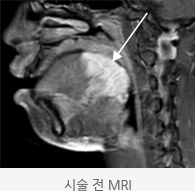 시술 전 정맥크기 MRI 모습