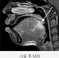 시술 후 정맥크기가 줄어든 MRI 모습